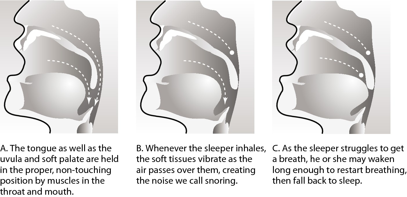 Figure 9-1: How snoring affects breathing.